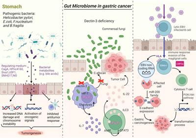 Interaction between intestinal flora and gastric cancer in tumor microenvironment